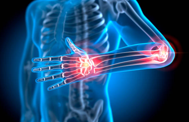 X Ray Illustration of Painful Hand and Elbow Joint - Medical 3D Illustration X Ray Illustration of Painful Hand and Elbow Joint - Medical 3D Illustration
